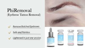 تتو ریمووال