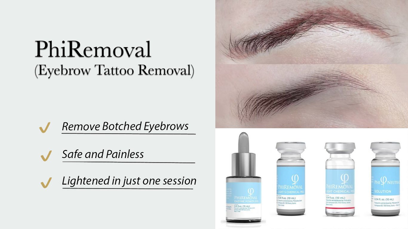 تتو ریمووال